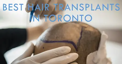 5 Best Hair Transplants in Toronto (2026)
