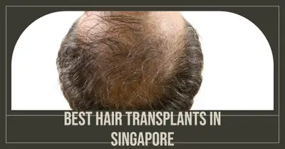 5 Best Hair Transplants in Singapore (2026)