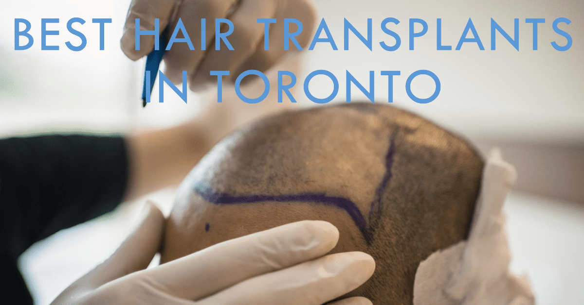Best Hair Transplants In Toronto (2026)