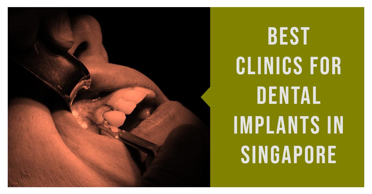 Best Clinics For Dental Implants In Singapore (2026)