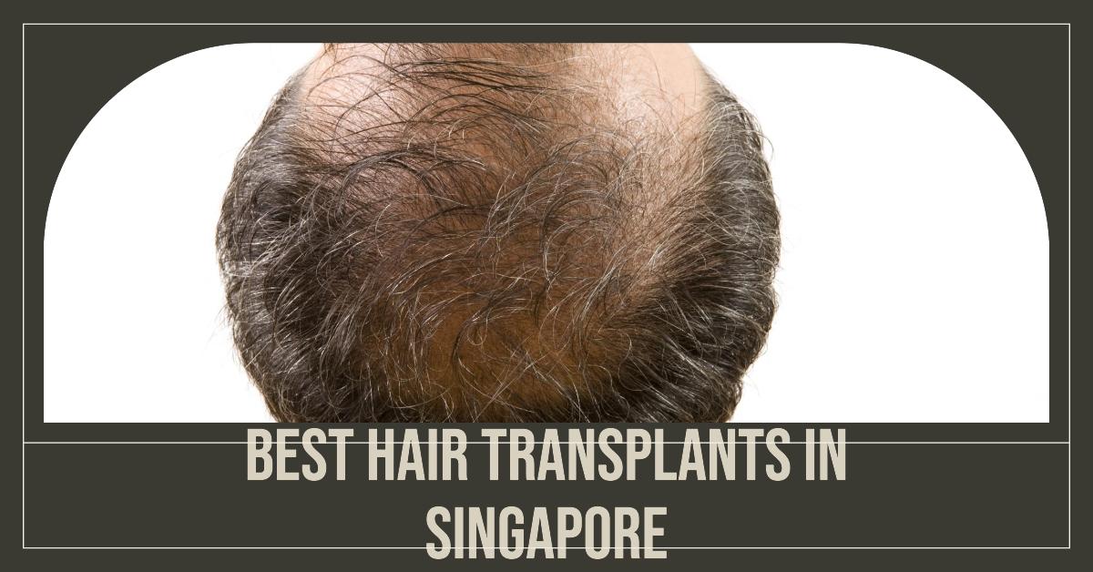 Best Hair Transplants In Singapore (2026)