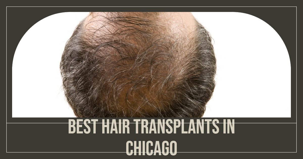 4 Best Hair Transplants In Chicago (2026)