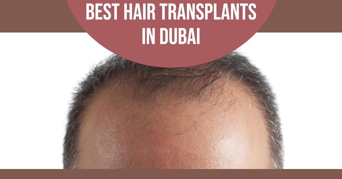 5 Best Hair Transplants In Dubai (2026)