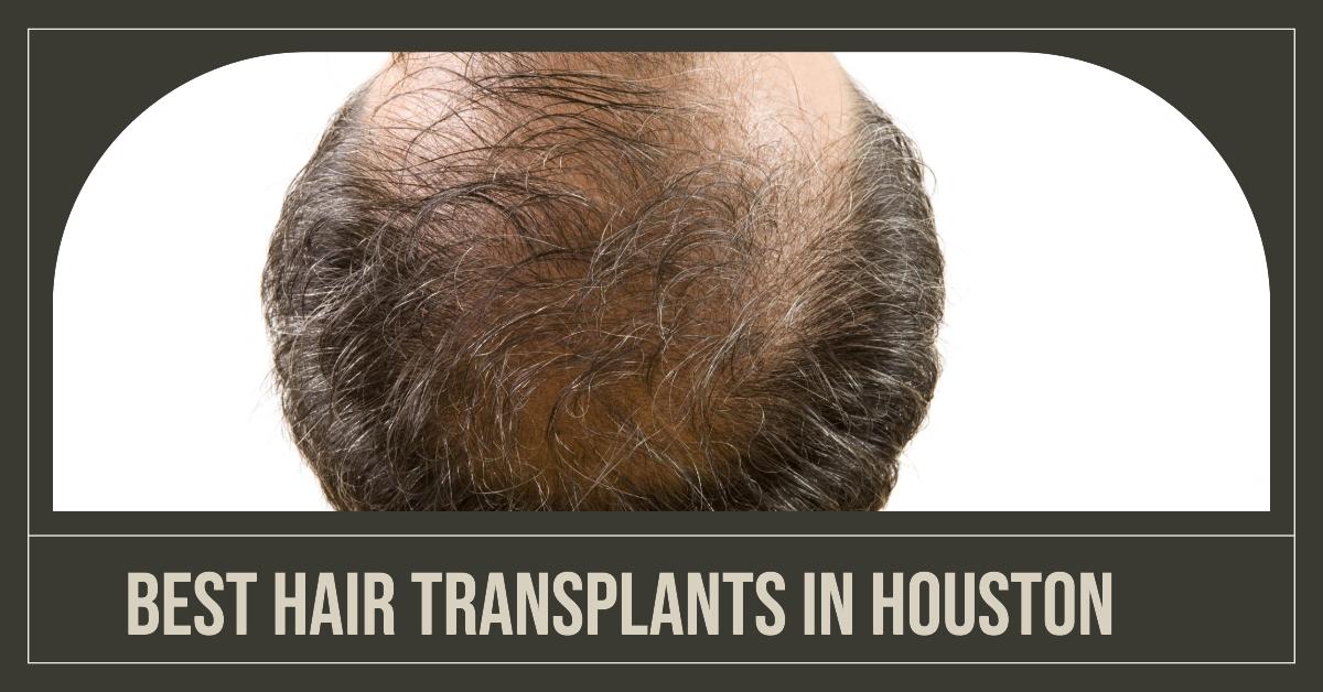 5 Best Hair Transplants In Houston (2026)
