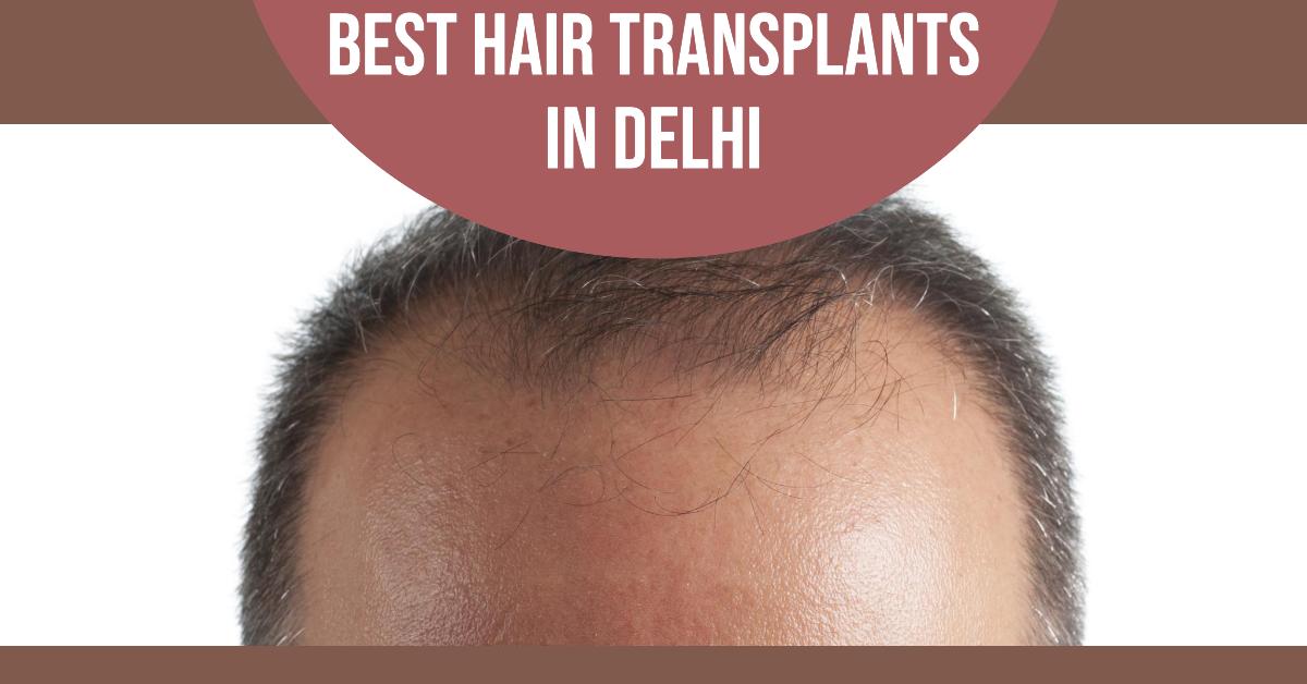 5 Best Hair Transplants In Delhi (2026)