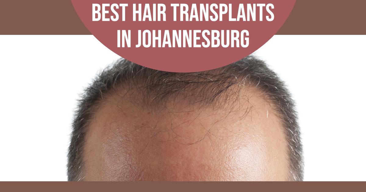 5 Best Hair Transplants In Johannesburg (2026)