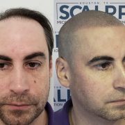 Scalpp Clinic : Scalp Micropigmentation Houston logo
